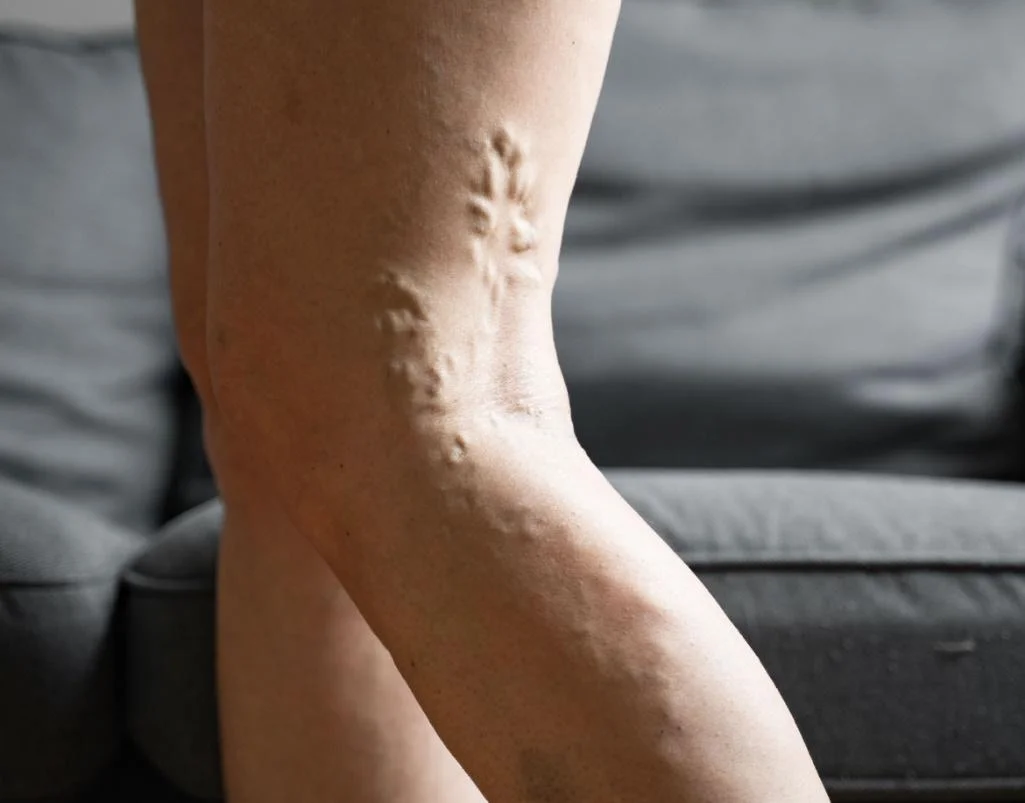 Chronic Venous Insufficiency Singapore