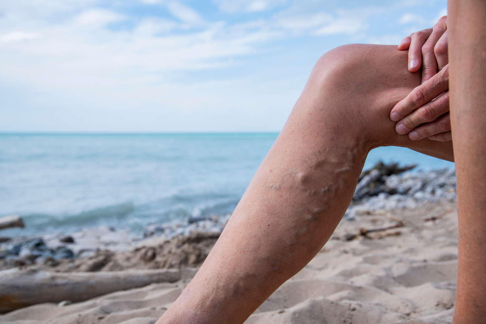 Varicose Veins & VEnous Reflux