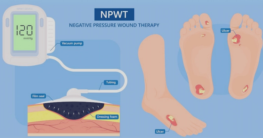 Diagram illustrating negative pressure wound therapy (NPWT), showing a vacuum pump connected to a wound via tubing, film seal, and dressing foam. The process removes fluid from the wound, promoting healing.