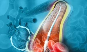 How Angioplasty Restores Blood Flow in Peripheral Vascular Disease