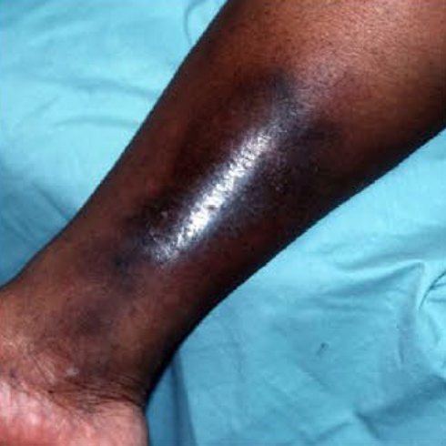 Skin Discoloration Lower Leg Skin Discoloration Lower Leg