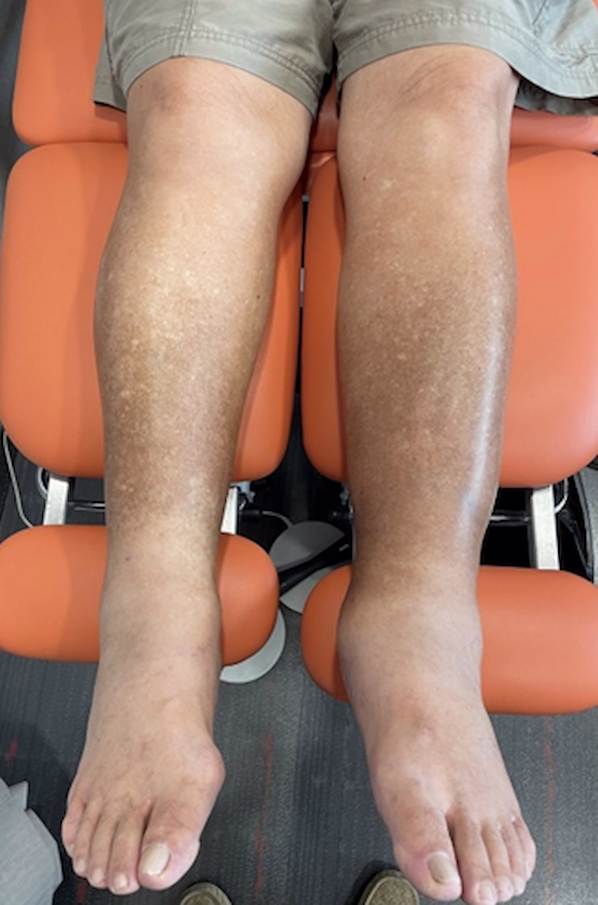 Leg discoloration