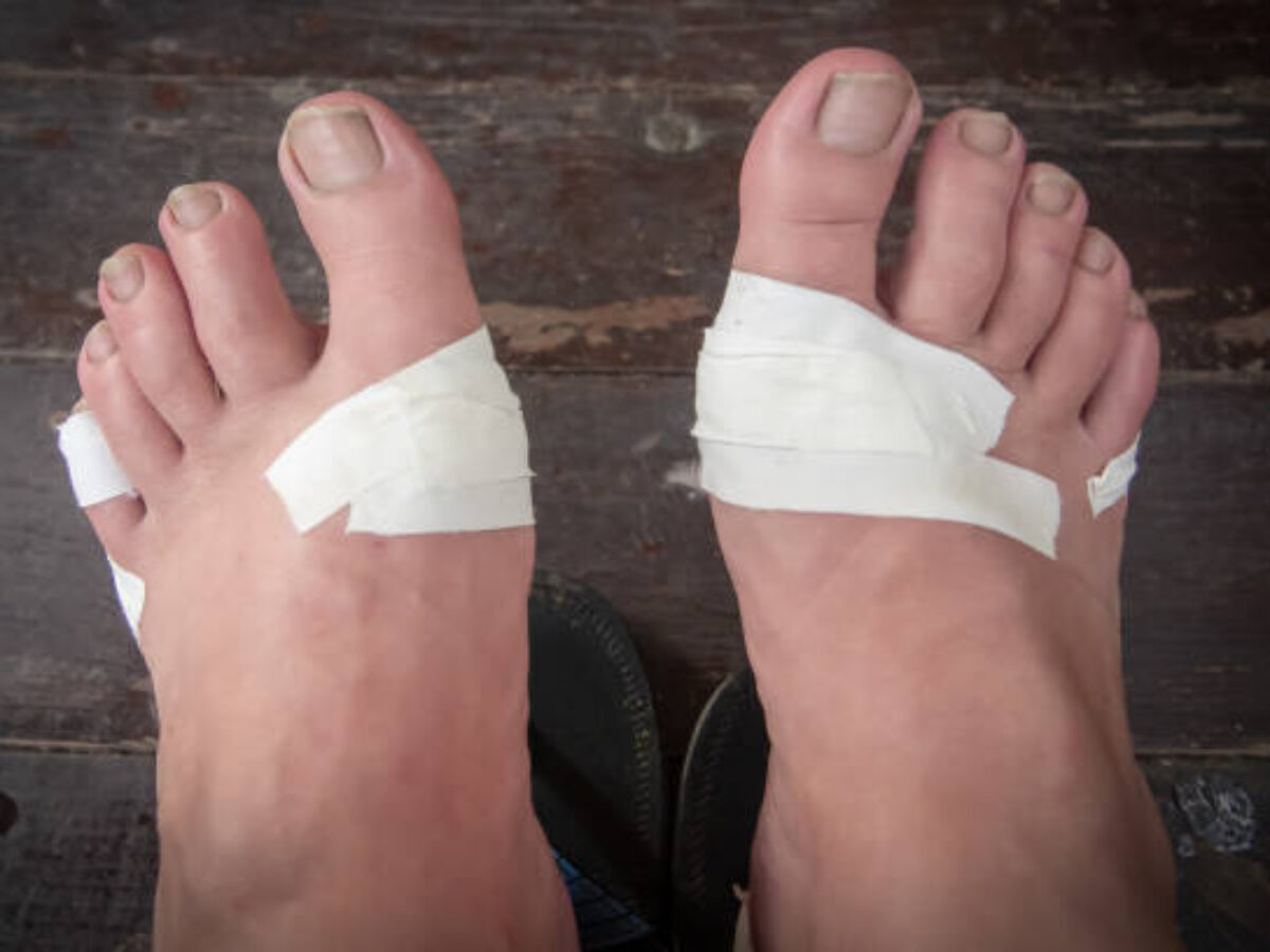 Non-Healing-Foot-Wounds-