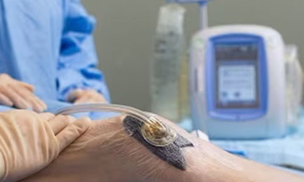 Understanding the Healing Power of VAC Dressings Understanding the Healing Power of VAC Dressings