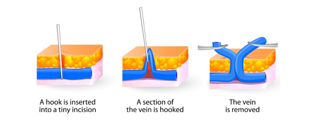 Mini Phlemectomies | Dr. Darryl Lim - Vascular Surgeon Singapore