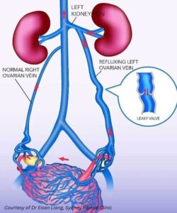 Ovarian vein reflux diagram showing normal right ovarian vein and refluxing left ovarian vein with leaky valve, illustrating the cause of pelvic congestion syndrome. Courtesy of Dr Eisen Liang, Sydney Fibroid Clinic.