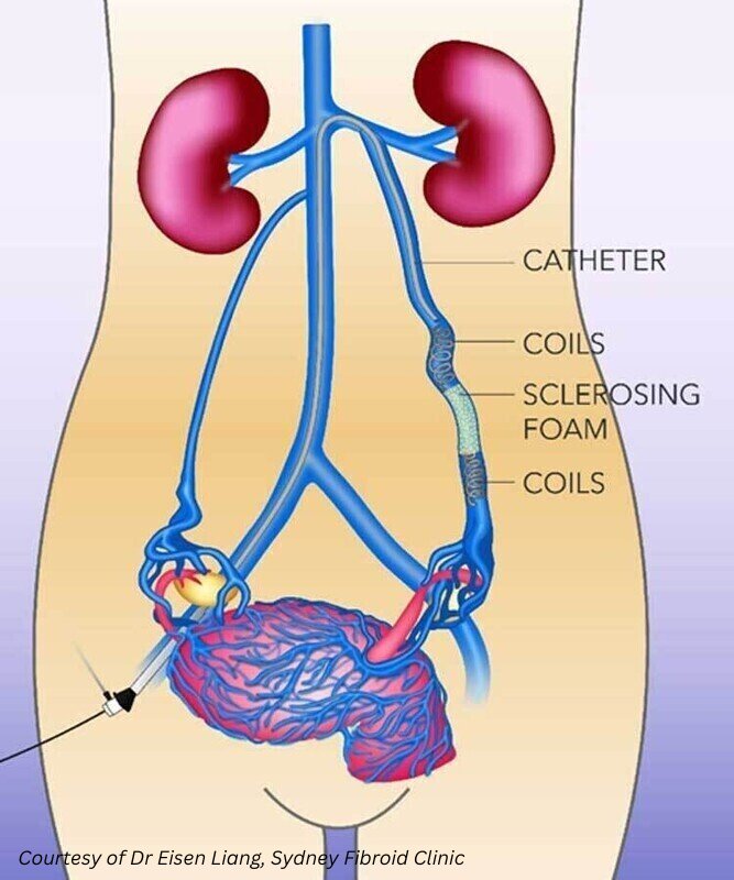 Ovarian vein embolization procedure showing catheter, coils, and sclerosing foam used to treat pelvic congestion syndrome. Courtesy of Dr Eisen Liang, Sydney Fibroid Clinic.