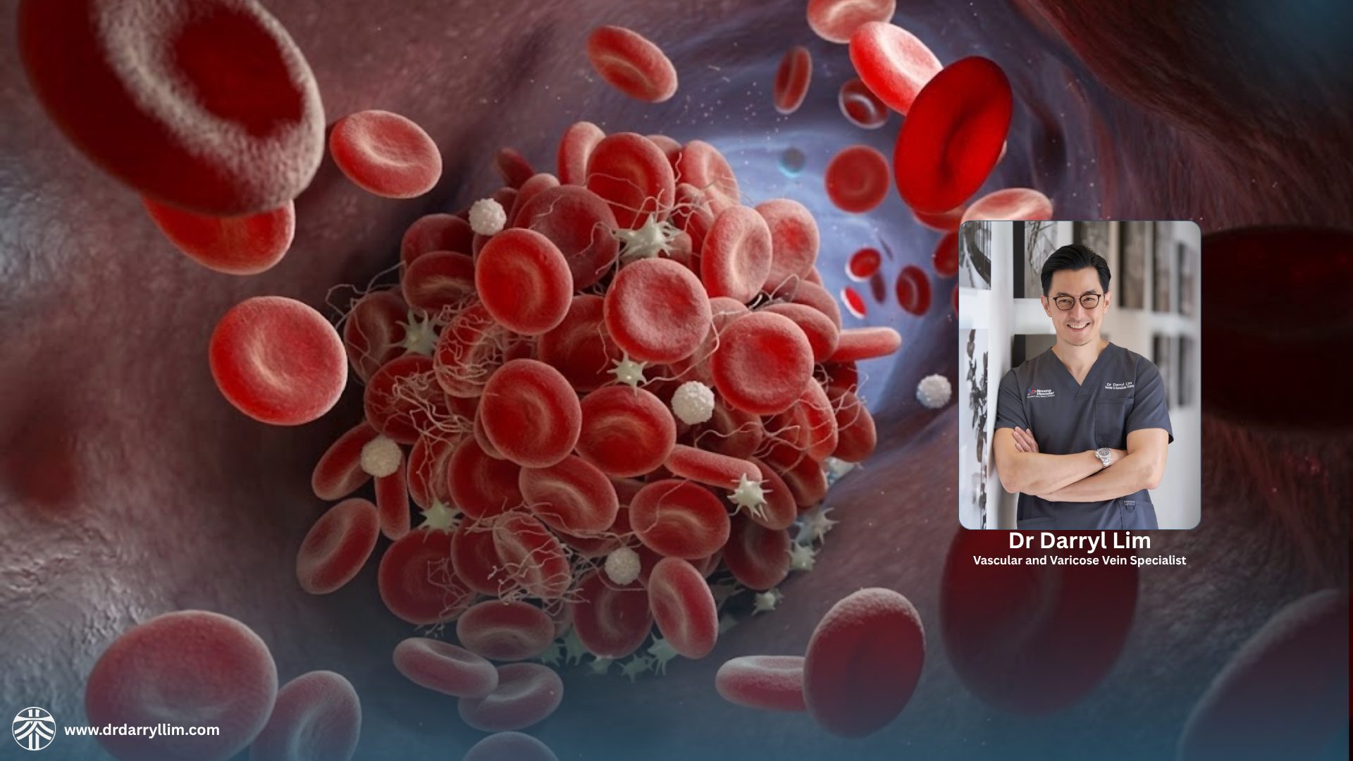 Deep vein thrombosis (DVT) treatment in Singapore