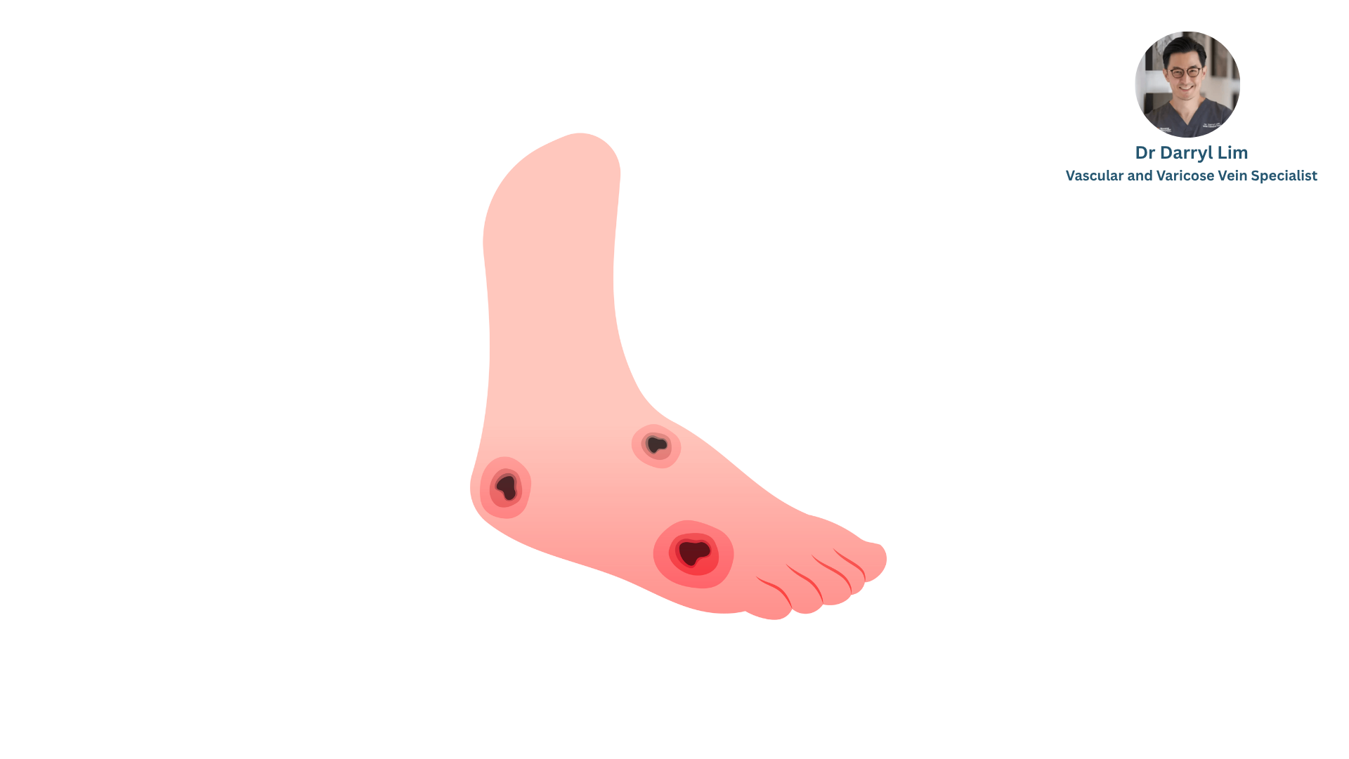 Deep Venous Arterialization (DVA)