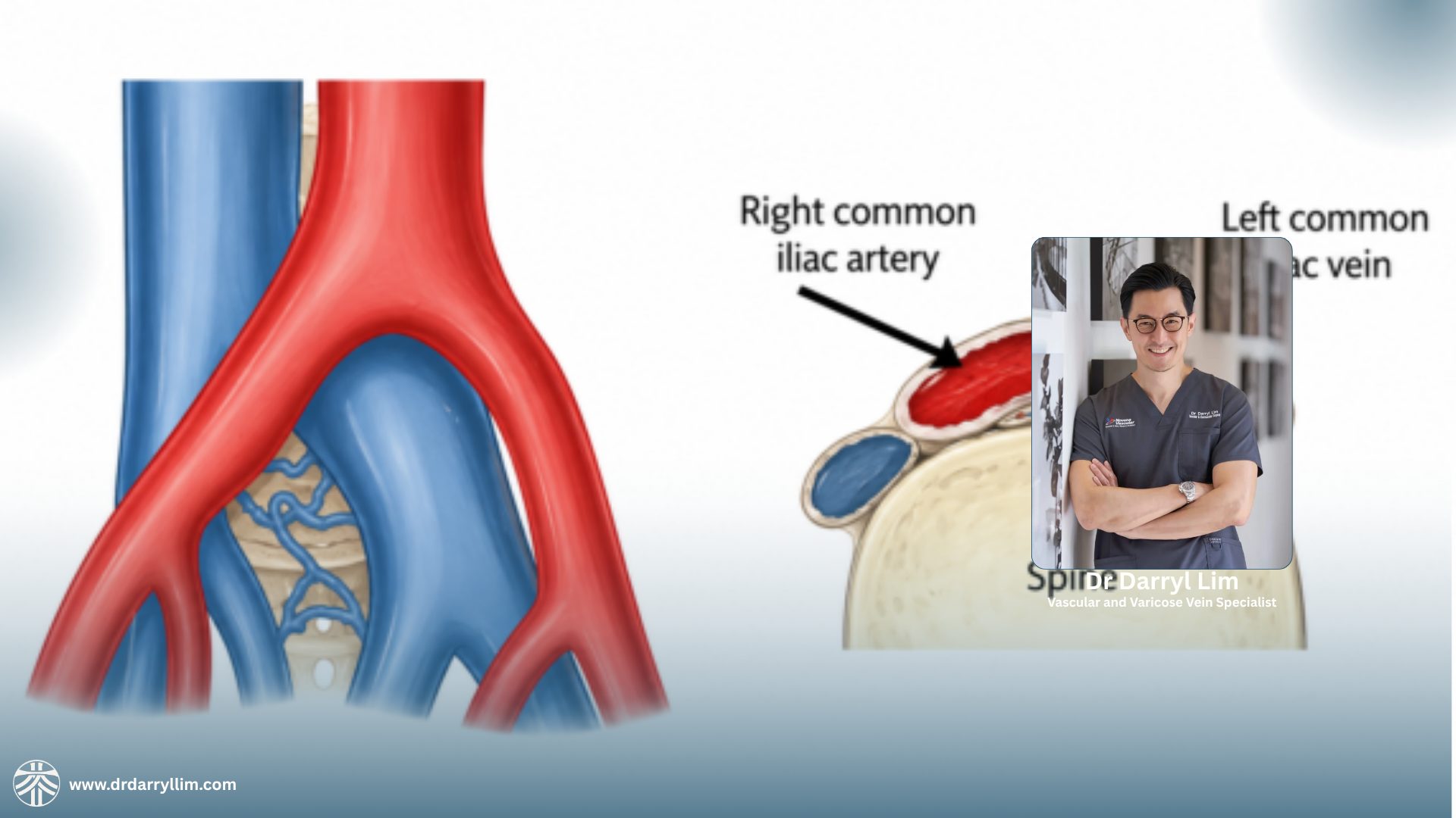 May-Thurner syndrome treatment in Singapore