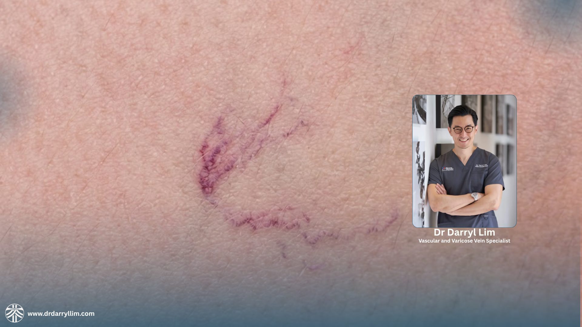 Spider vein removal treatment in Singapore