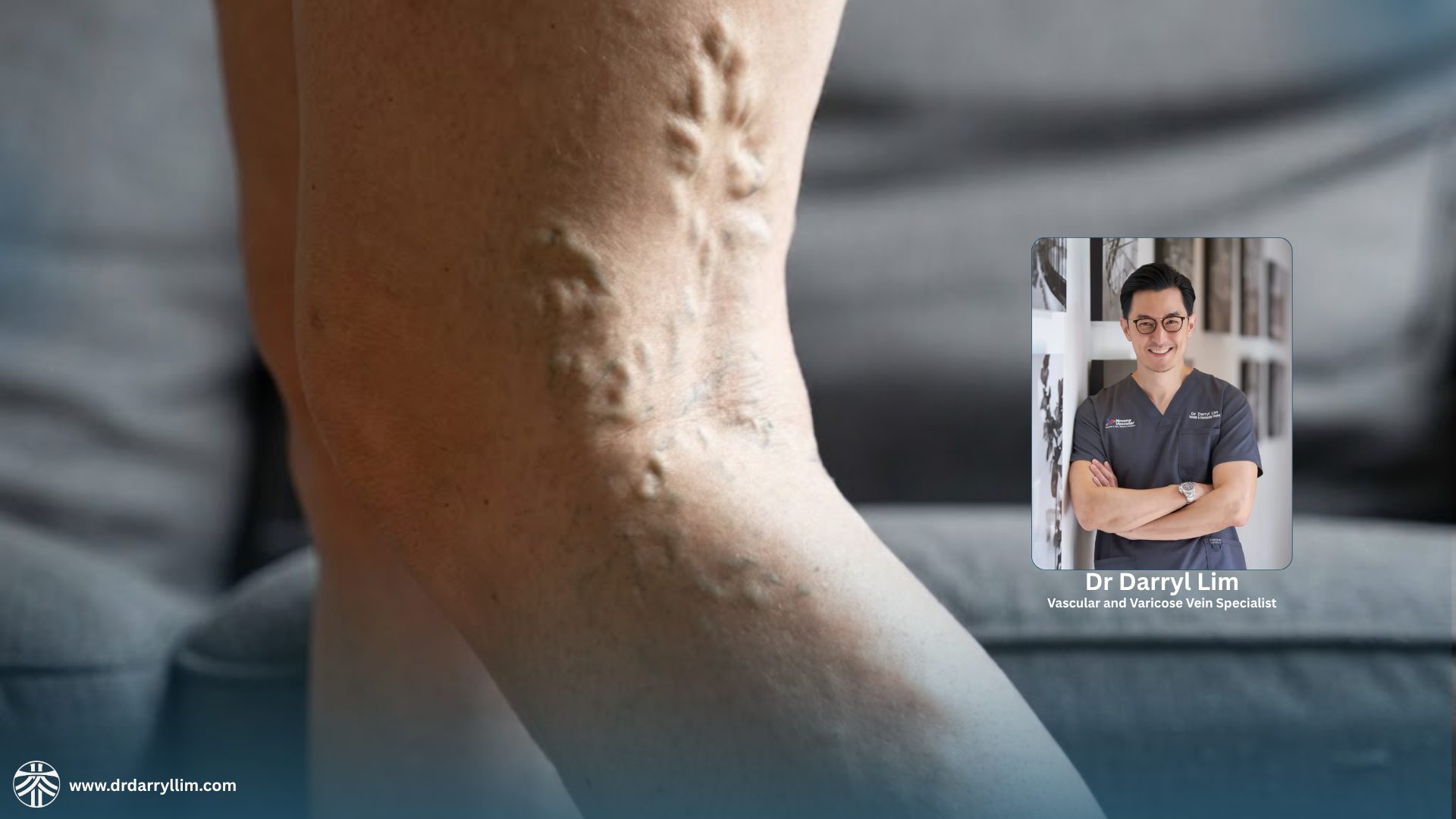 Varicose vein treatment in Singapore