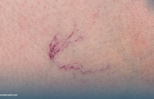 Spider Veins
