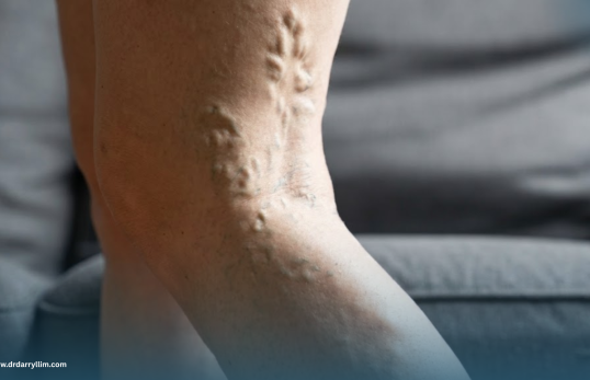 Varicose Veins
